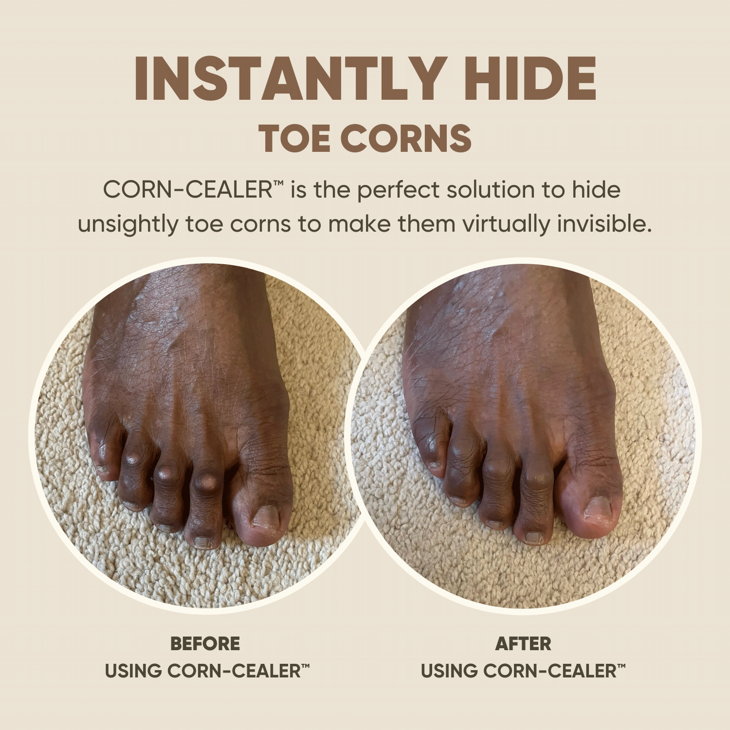 Toe Corn Concealer provides flawless coverage for toe corns. Before and after comparison shows instant, natural-looking results.